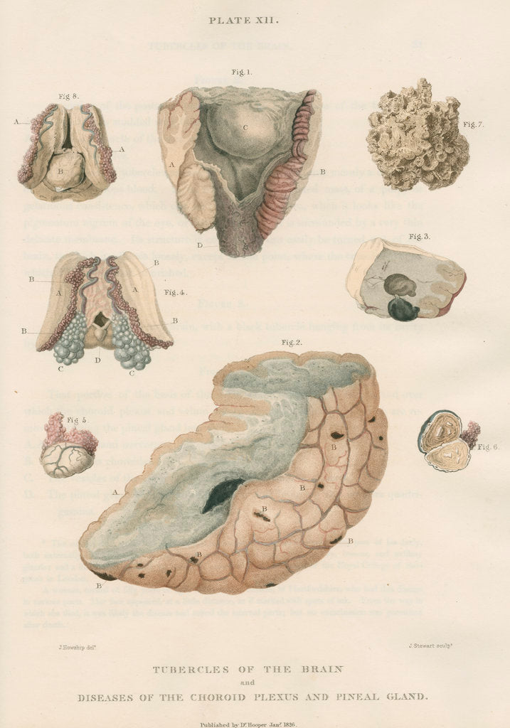 Detail of 'Tubercles of the brain' by J Stewart senior