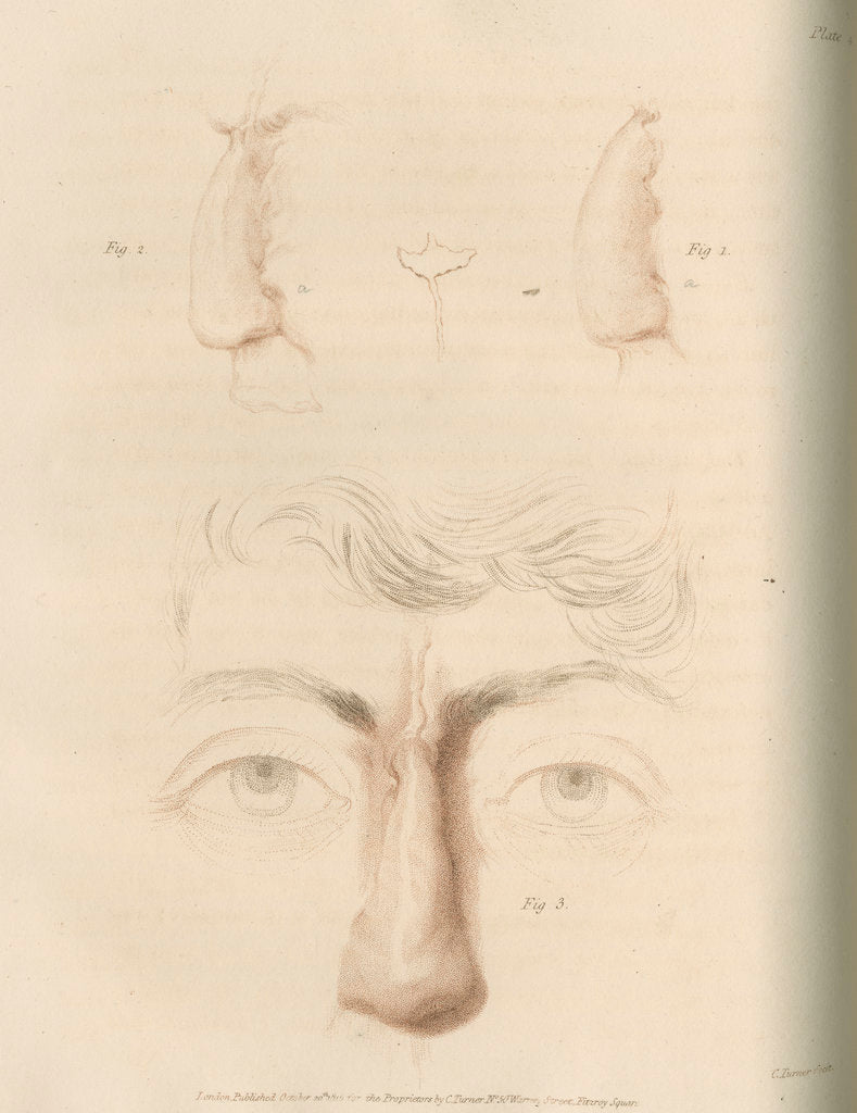 Detail of A successful nose replacement using the Indian Method by Charles Turner