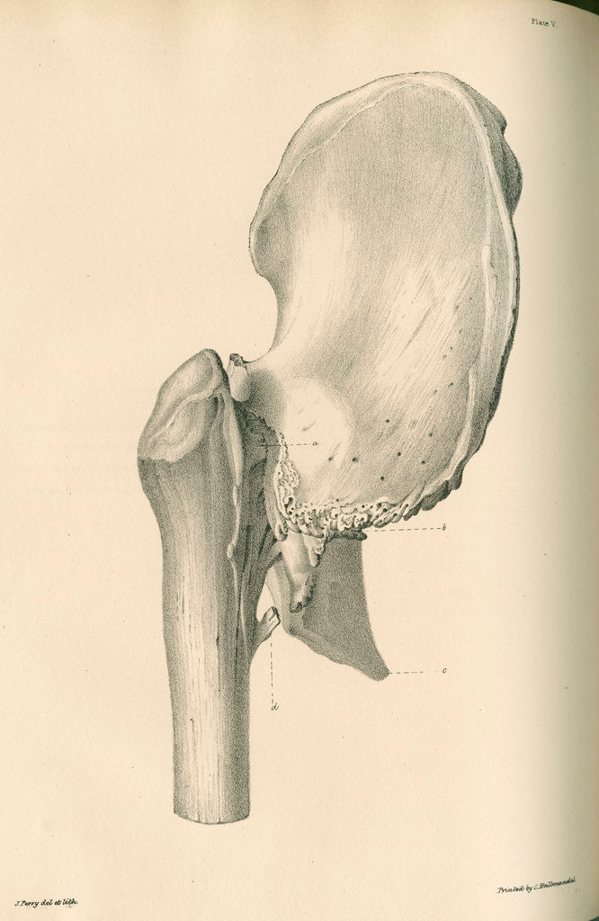 Detail of Lateral view of anchylosis of the right femur with the hip bone by J Perry