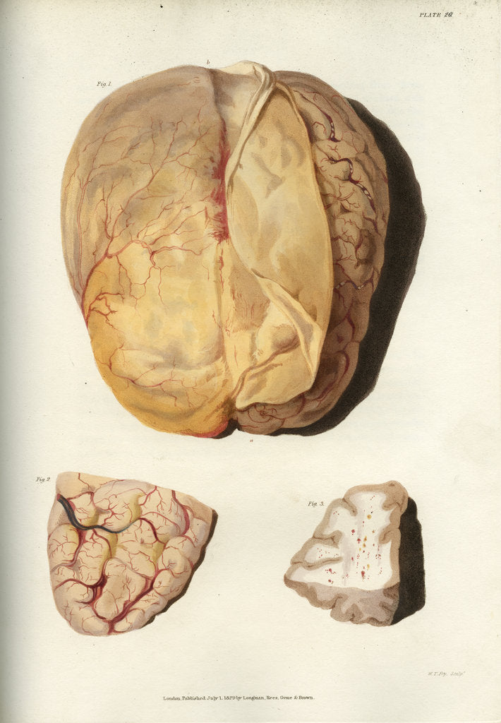 Detail of 'Effects of jaundice on the brain and its membranes' by William Thomas Fry