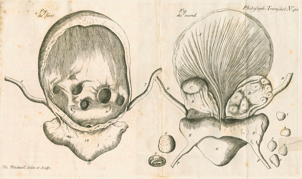 Detail of Human bladder and bladder stones by Elizabeth Blackwell