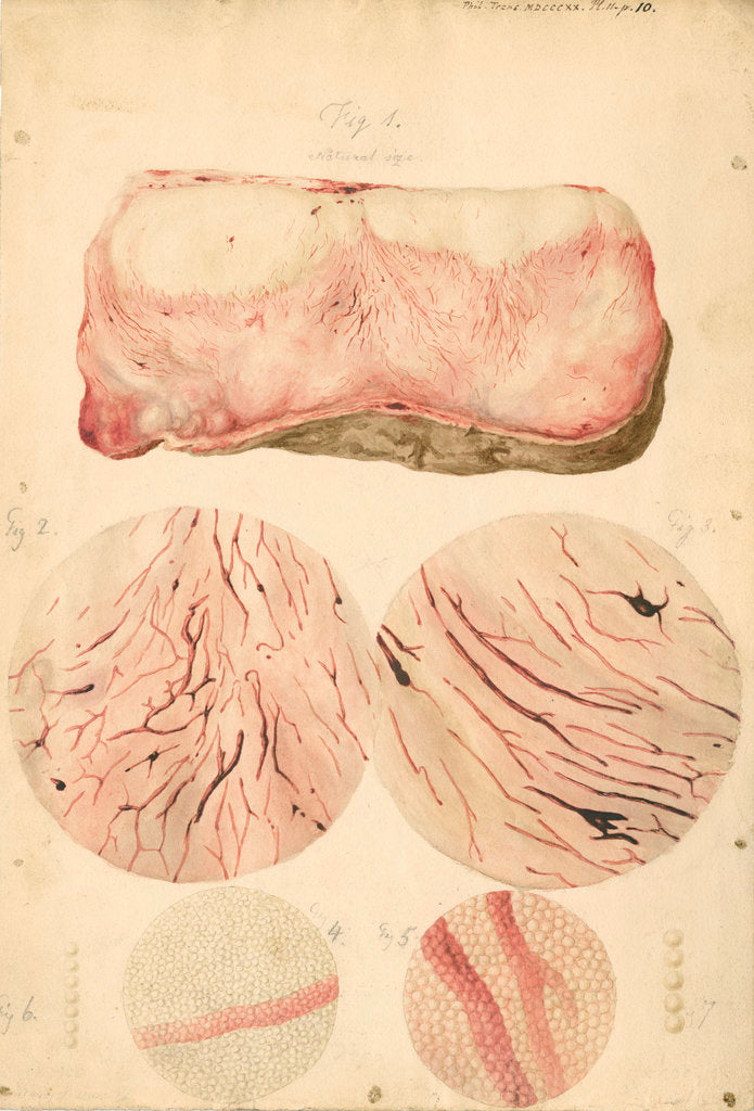 Detail of Tumor with human blood lymph cells by Franz Andreas Bauer