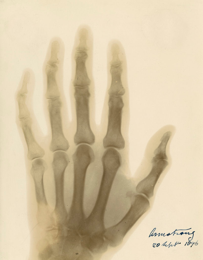 Detail of X-ray photograph of the hand of William George Armstrong by Alan Archibald Campbell Swinton