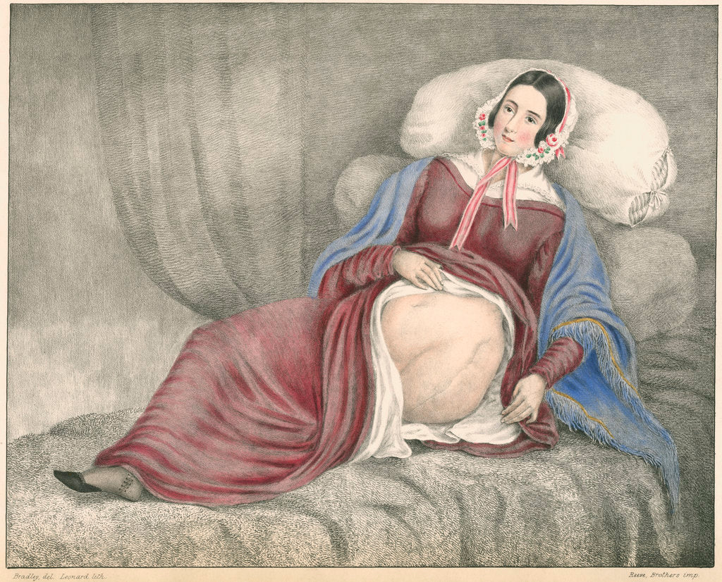 Detail of Portrait of Elizabeth Powis showing a leg amputation by Leonard