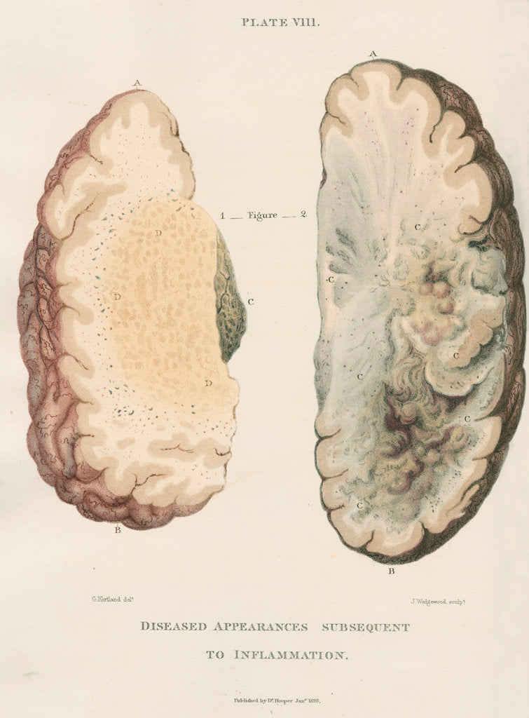 'Inflammation of the brain' by J Wedgewood