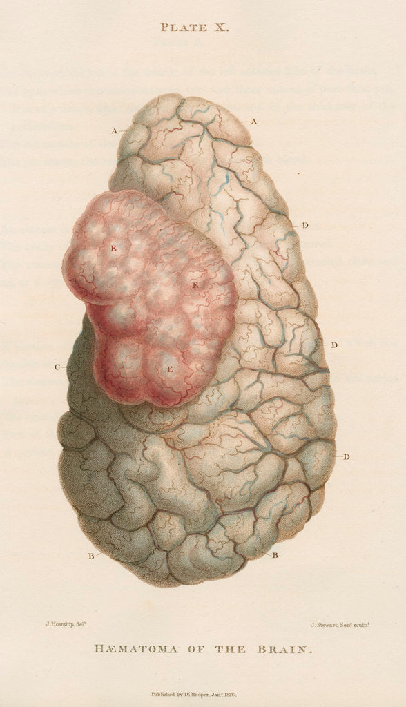 Detail of 'Haematoma of the brain' by J Stewart senior
