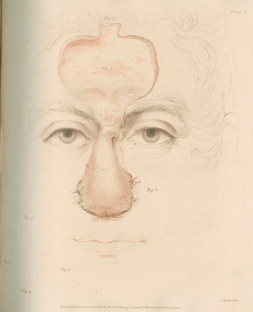 Detail of The Indian Method of nose replacement by Charles Turner