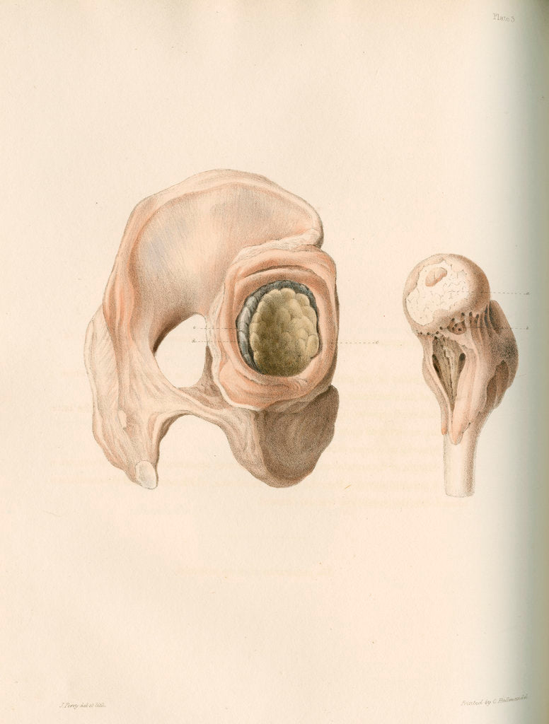 Detail of Hip and femur by G Hallmandel