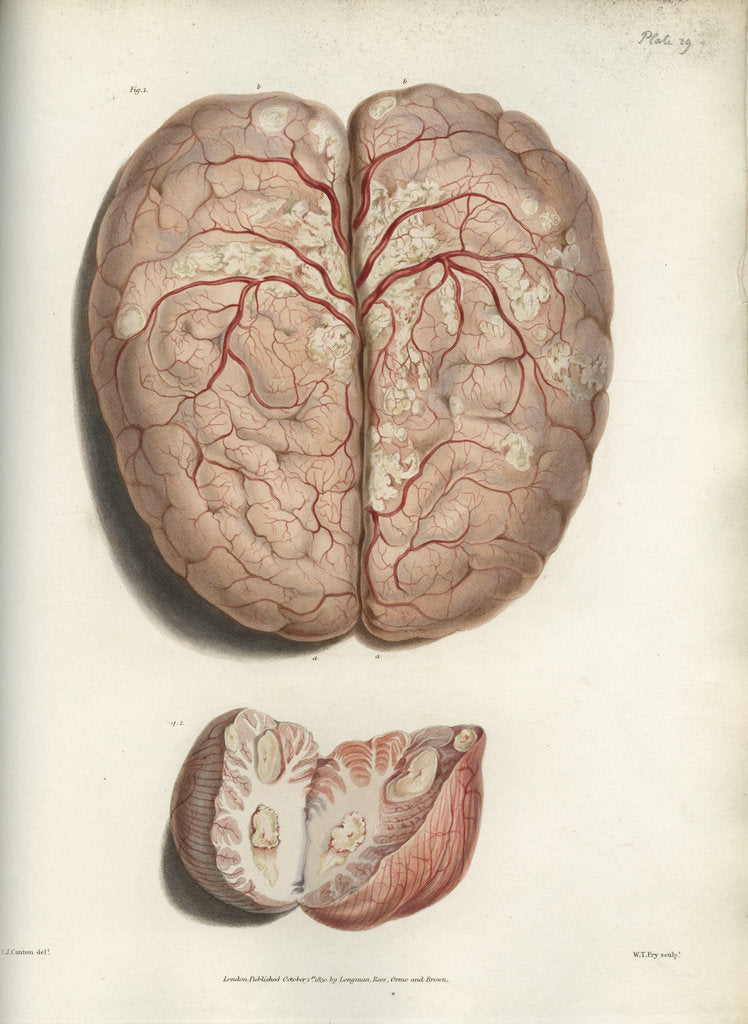 Detail of 'Scrofulous tubercles in the brain' by C J Canton