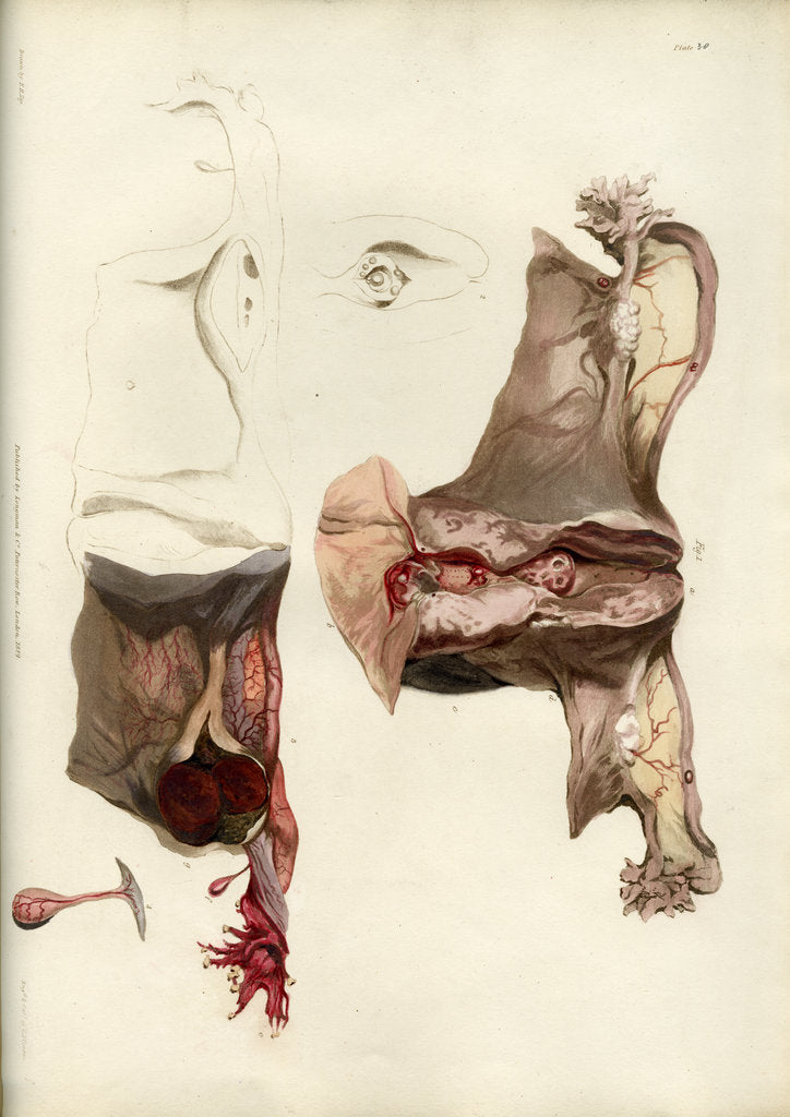 Detail of 'Diseases of the uterus giving rise to excessive nervous irritation' by C J Canton